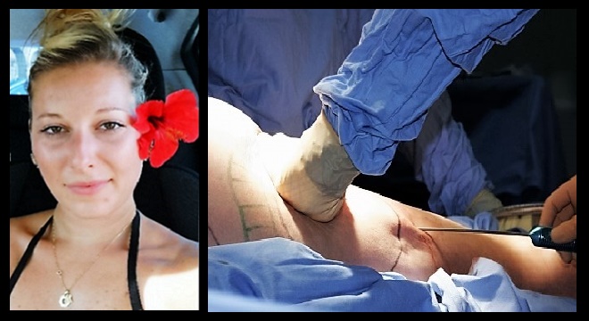 Décès de Marjorie Quitero au cours d’une Liposuccion : Pas d’erreur médicale, selon l’Institut médico-légal de Lyon