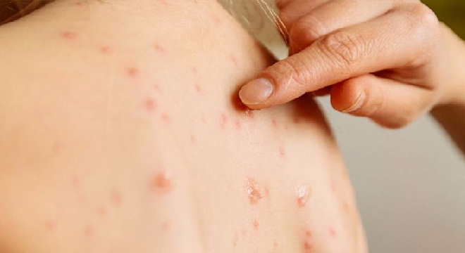 Rougeole : 580 contaminations enregistrées depuis janvier 2019