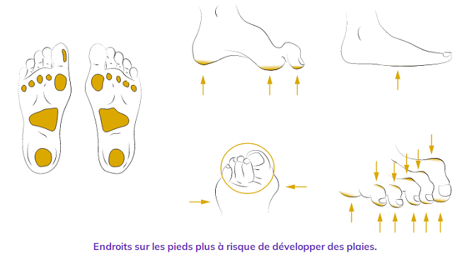 protéger les pieds d'un diabétique